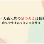 ミセス・大森元貴の足のあざは怪我なの？-病気や生まれつきの可能性は！